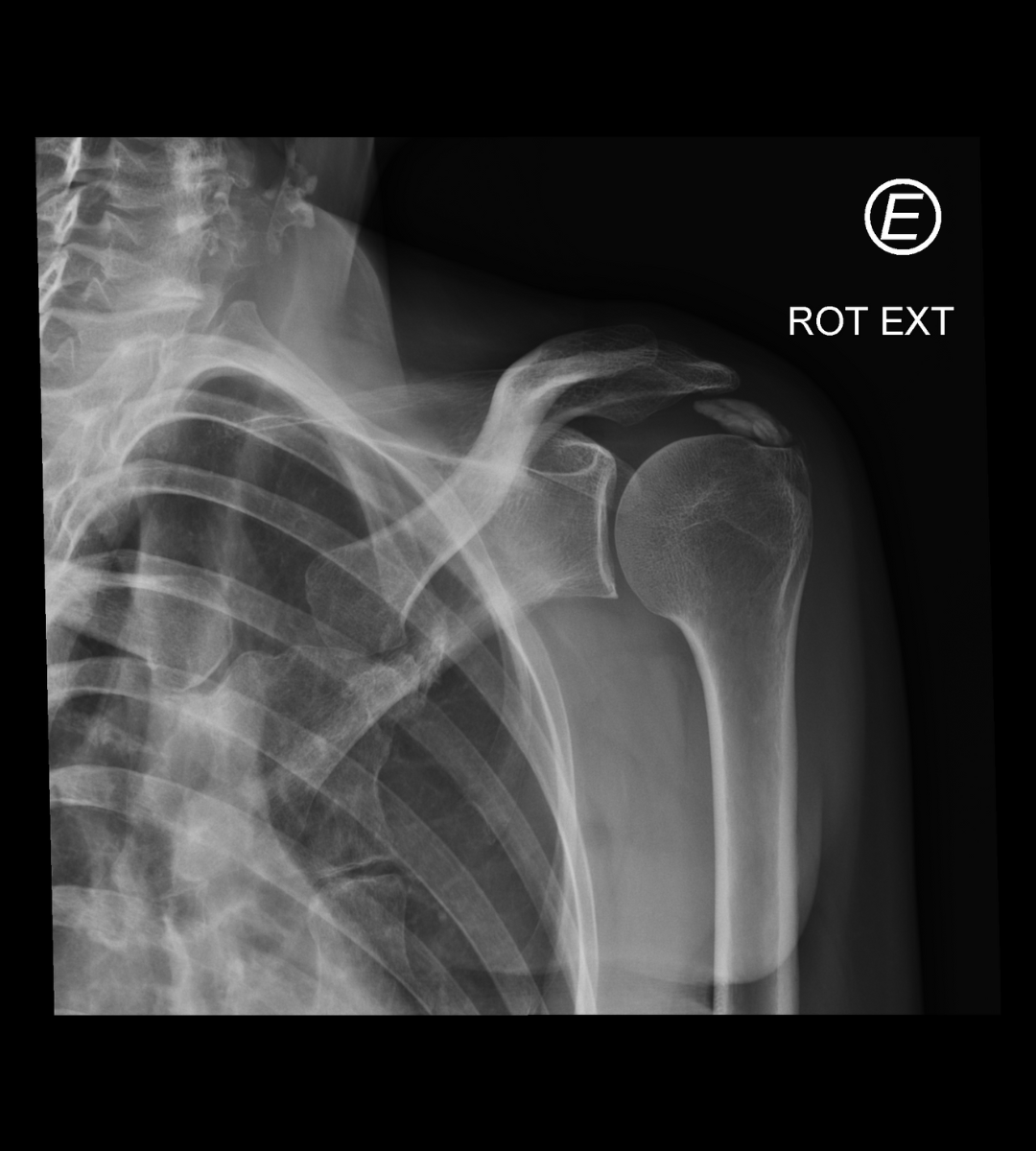 Vivendo Bem Com o Ombro Saudável: Dicas de Longo Prazo - inspiração 2