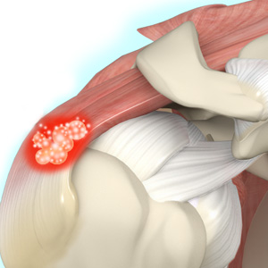 Diagnóstico: Como o Médico Identifica a Tendinite Calcária? - inspiração 1