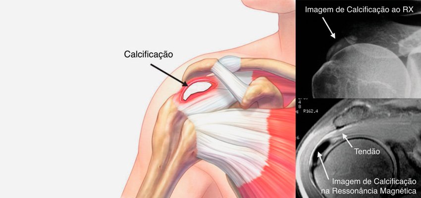 Diagnóstico: Como o Médico Identifica a Tendinite Calcária? - inspiração 2