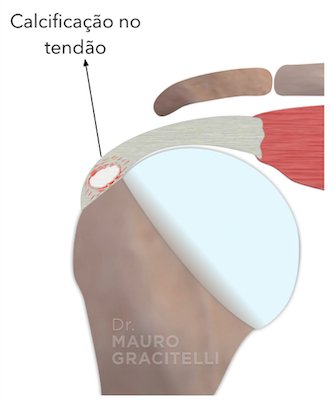 Fases da Tendinite Calcária: Do Início à Resolução - inspiração 1