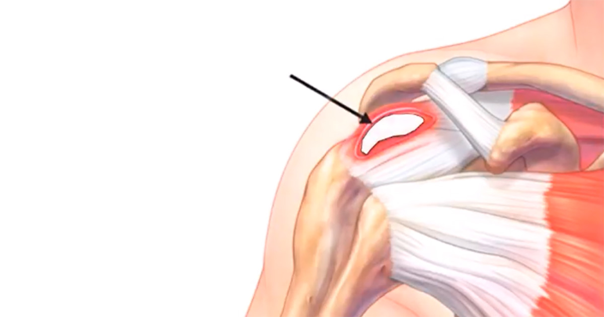 Prevenção: Evitando Novas Calcificações - inspiração 2