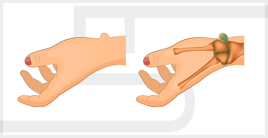 O cisto é visível ou apenas sinto? - inspiração 1