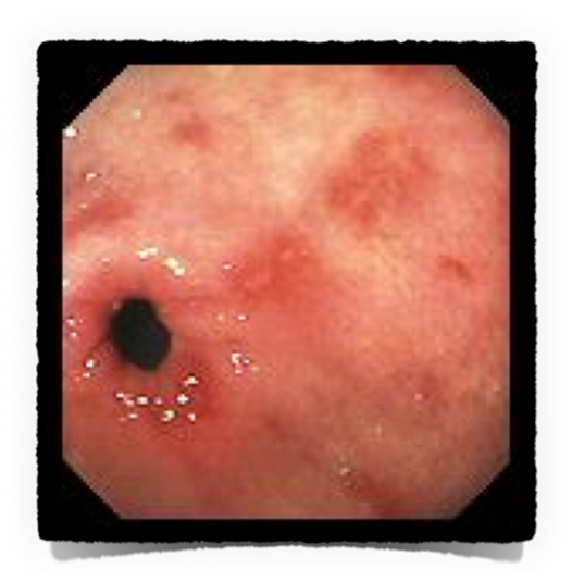 O Papel do Helicobacter pylori: O Principal Vilão? Entenda a Infecção - inspiração 1