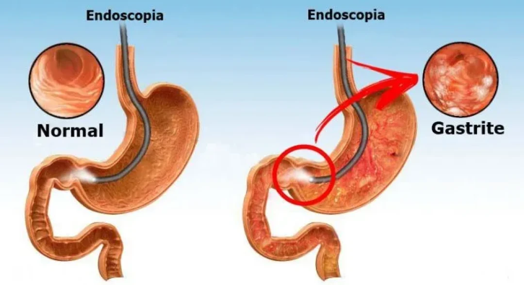 O Papel do Helicobacter pylori: O Principal Vilão? Entenda a Infecção - inspiração 2