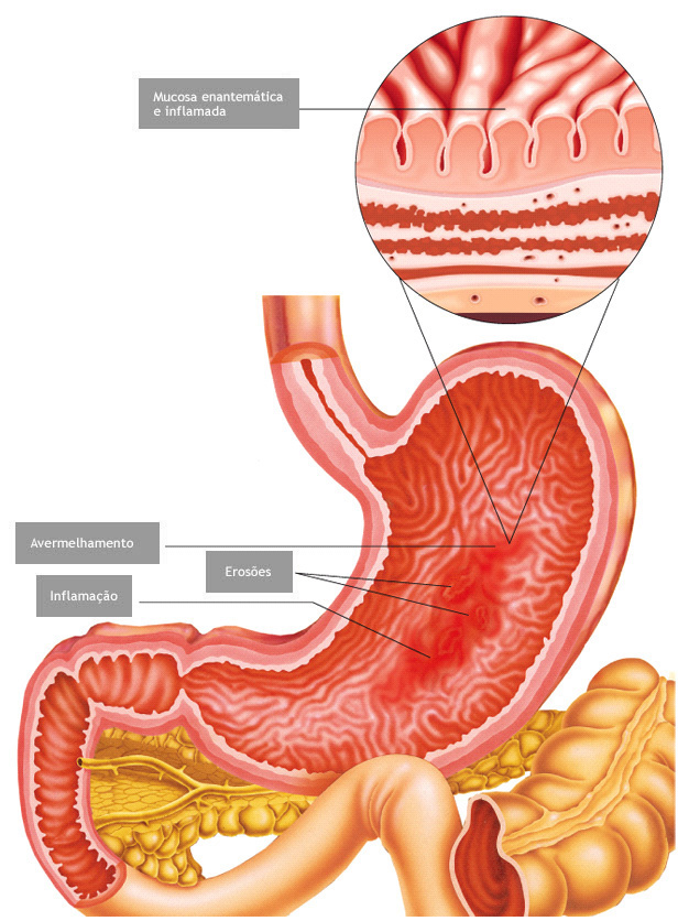Entendendo a Inflamação: O que realmente acontece com seu estômago - inspiração 1