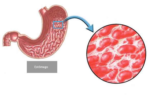 Evitando Gatilhos Comuns: Identifique e fuja do que piora sua gastrite - inspiração 1
