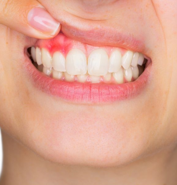 Alimentos Que Ajudam e Que Prejudicam Sua Gengiva - inspiração 2