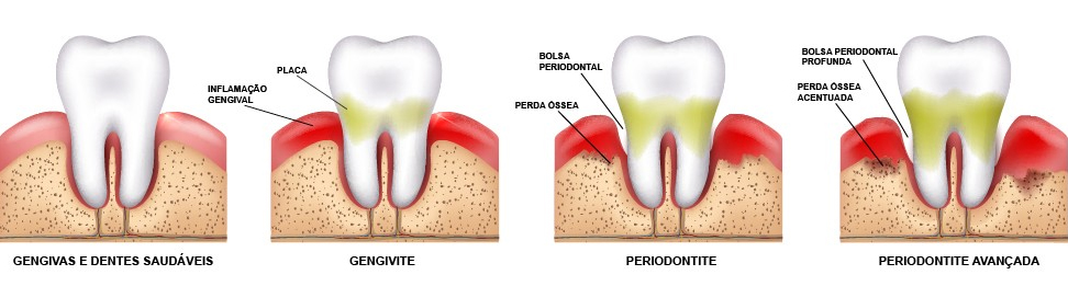 O Poder do Fio Dental: Essencial para Remover o Que a Escova Não Alcança - inspiração 2