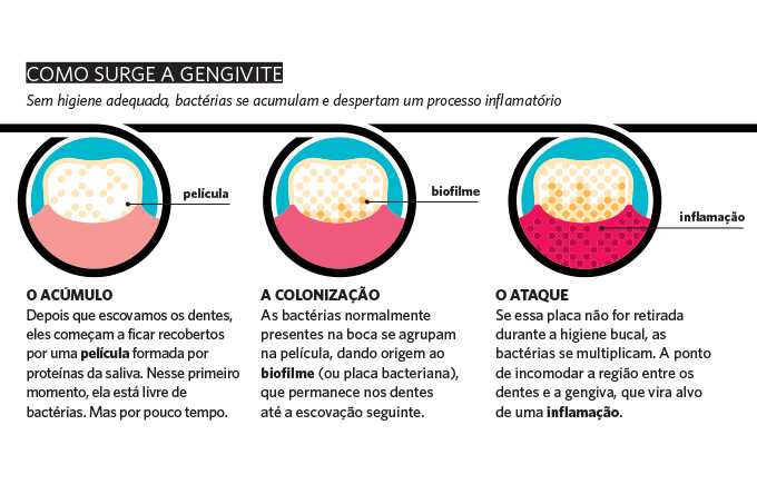 O Que Realmente é a Gengivite Expulsiva? Entenda a Causa Raiz. - inspiração 1