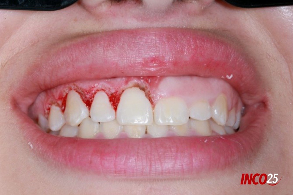 O Que Evitar Para Não Piorar Seu Caso de Gengivite Expulsiva. - inspiração 2