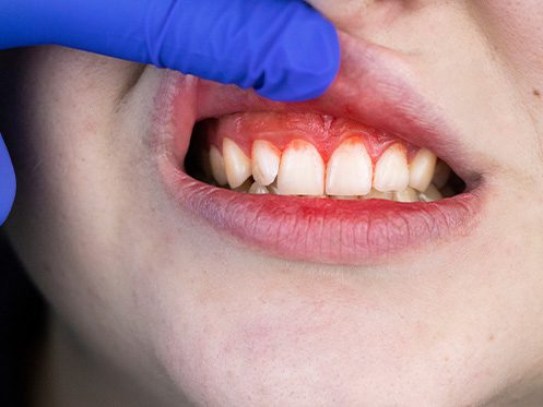 Por que a gengivite surge mais nessa fase? - inspiração 2