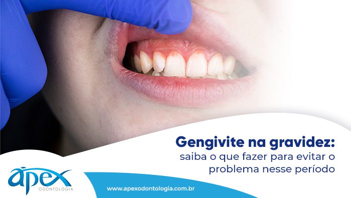 Os riscos de não tratar a gengivite durante a gestação - inspiração 1