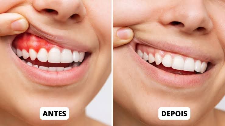 Os riscos de não tratar a gengivite durante a gestação - inspiração 2