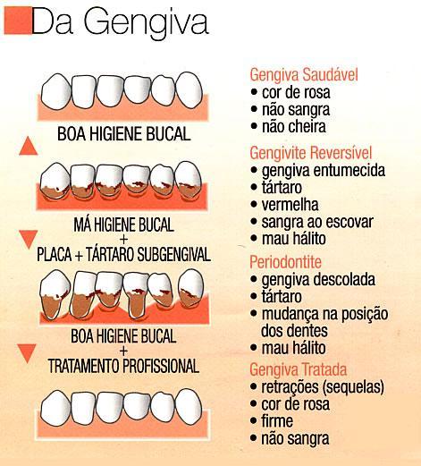 Alimentação e gengivite: o que você precisa saber - inspiração 2