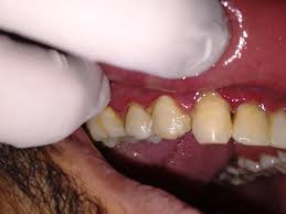 Cuidados Pós-Tratamento: Mantendo a Saúde Bucal do Seu Filho - inspiração 1