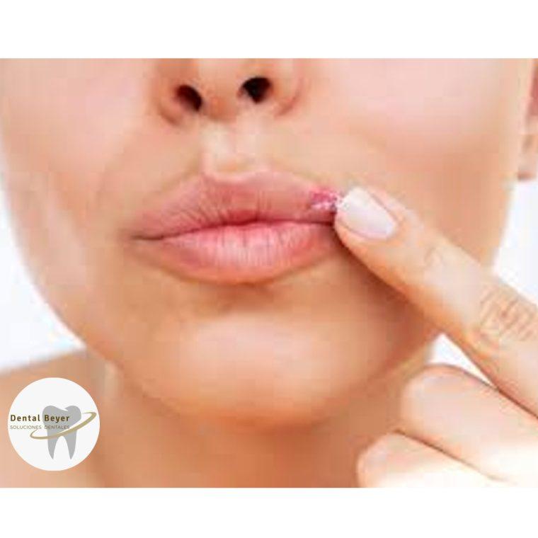 Antivirais Orais: Quando a Medicação Interna é Essencial - inspiração 1