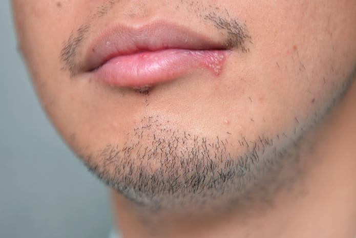 Antivirais Orais: Quando a Medicação Interna é Essencial - inspiração 2