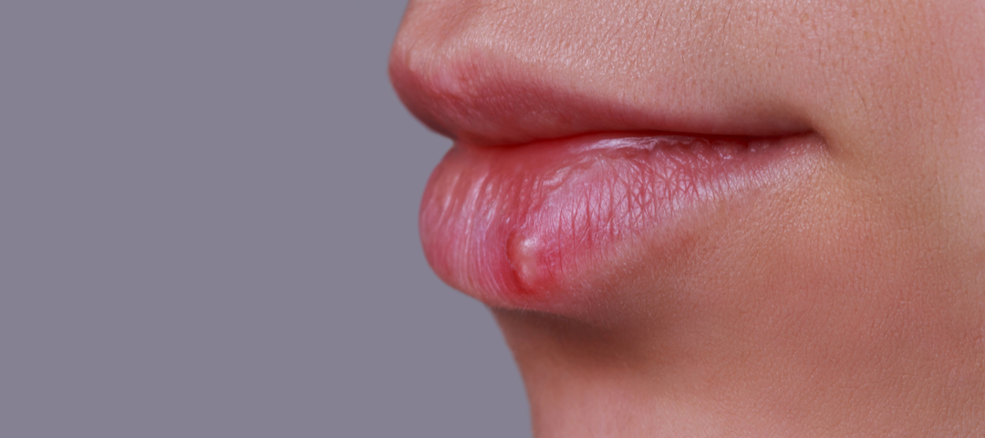 Mitos e Verdades Sobre a Herpes Labial: Desmistificando o Assunto - inspiração 1