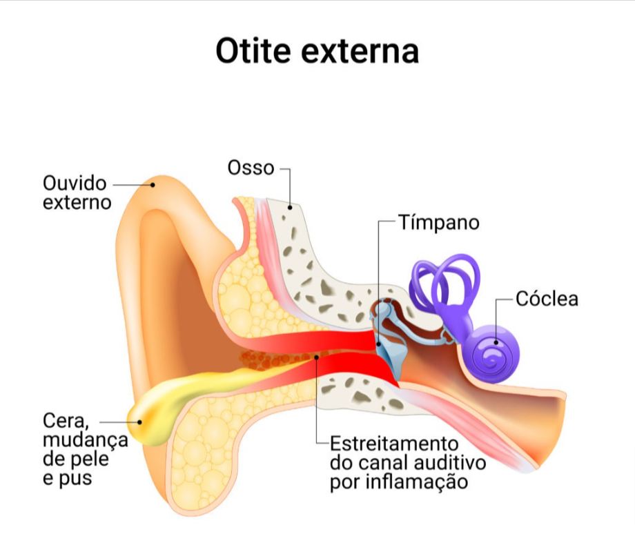 Otite Externa: O Ouvido Que Sofre por Fora - inspiração 1