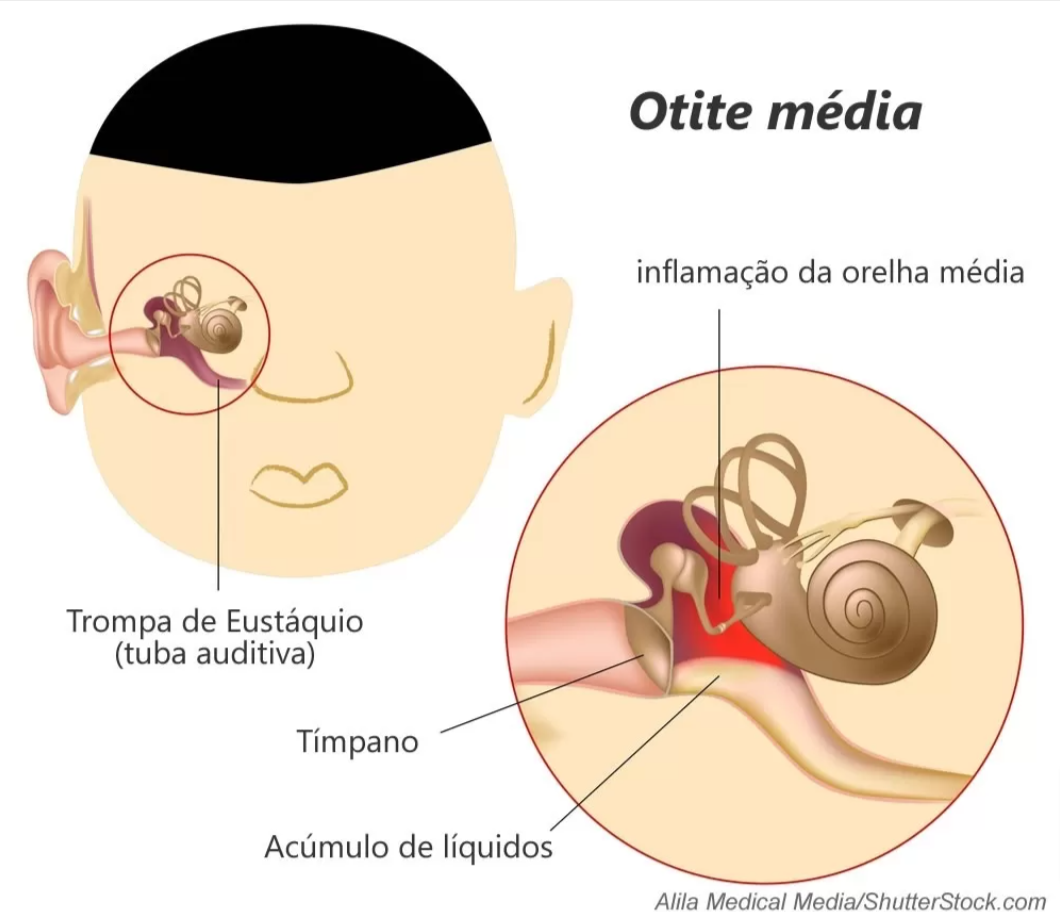 Otite Externa: O Ouvido Que Sofre por Fora - inspiração 2