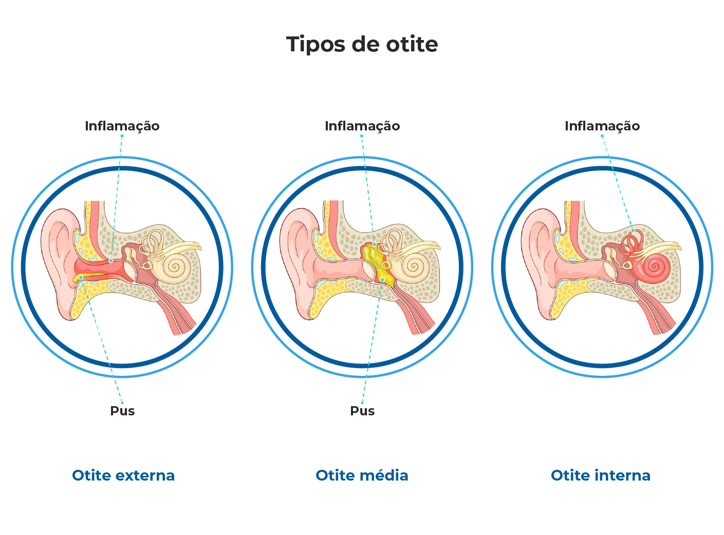 Fatores Que Favorecem o Surgimento da Otite - inspiração 2