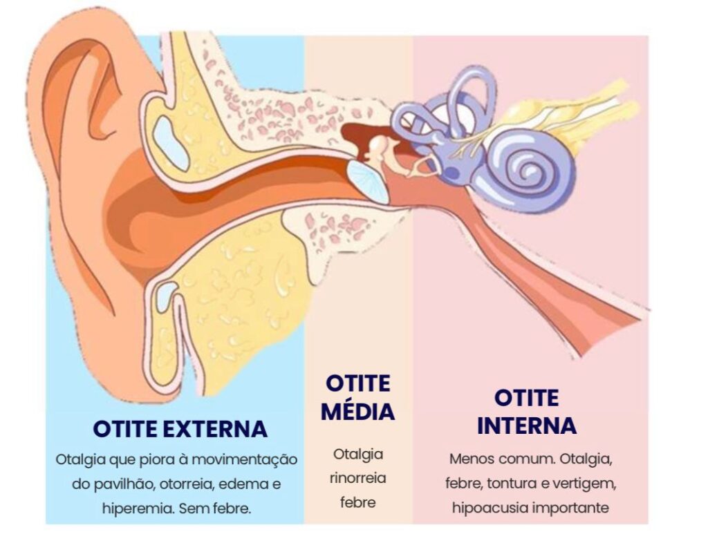 Cuidados Específicos Para Otite Externa - inspiração 1