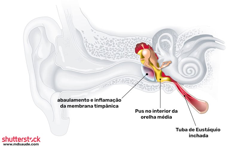Otite em Crianças: Atenção Redobrada - inspiração 1
