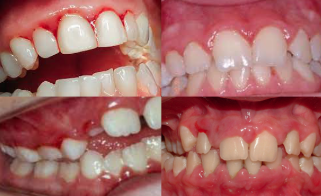 Quando Considerar a Cirurgia Periodontal - inspiração 1