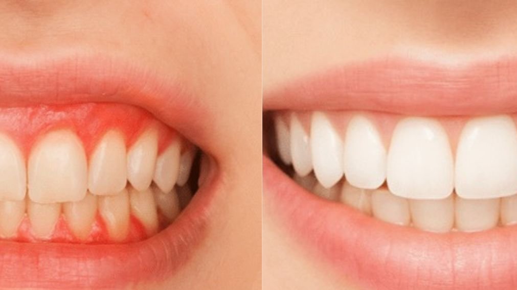 Prevenção de Recaídas: Mantendo Seu Sorriso Saudável a Longo Prazo - inspiração 1