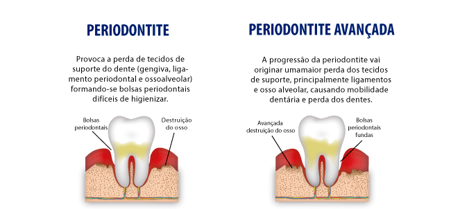 Limpeza Profunda (Raspagem e Alisamento Radicular): Removendo a Causa - inspiração 1