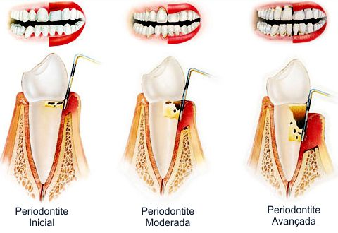 Limpeza Profunda (Raspagem e Alisamento Radicular): Removendo a Causa - inspiração 2
