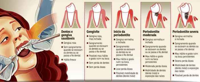 Antissépticos Bucais: Um Reforço Importante - inspiração 1