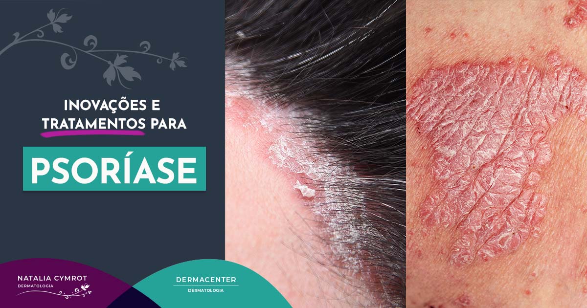 Vivendo bem com a psoríase: dicas de bem-estar - inspiração 1