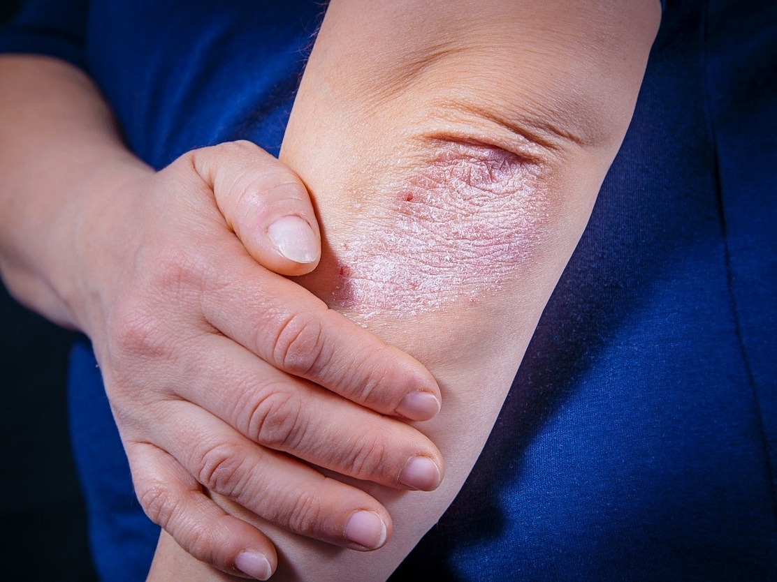 O papel da alimentação no controle da inflamação - inspiração 2