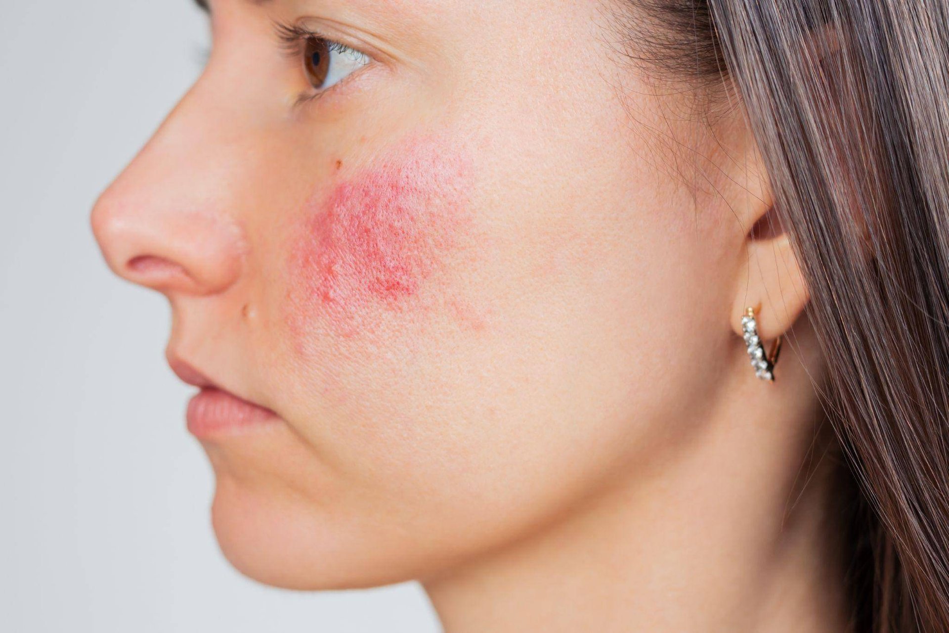 Como o estresse impacta a psoríase e o que fazer - inspiração 1