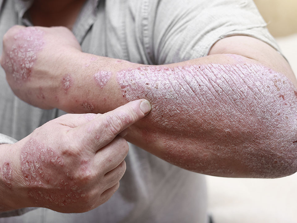 Como o estresse impacta a psoríase e o que fazer - inspiração 2