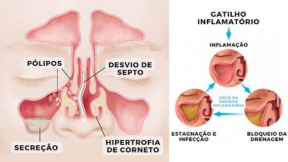 O Que Define a Sinusite Crônica e Por Que Ela Persiste? - inspiração 1