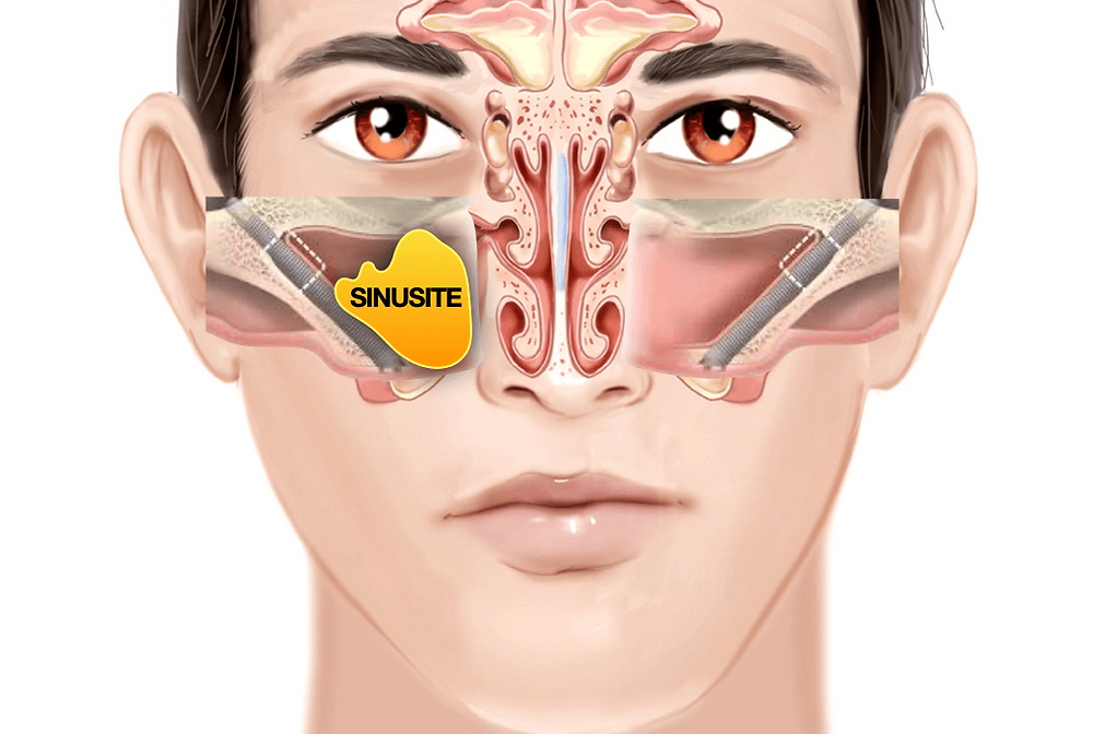 Fatores de Risco: Quem Está Mais Susceptível à Sinusite Crônica? - inspiração 1