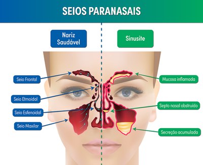 Lavagem Nasal com Solução Salina: O Essencial - inspiração 1