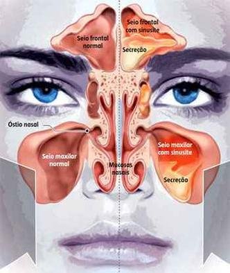 Umidificadores de ar: mantenha o ambiente úmido para não ressecar as mucosas - inspiração 1