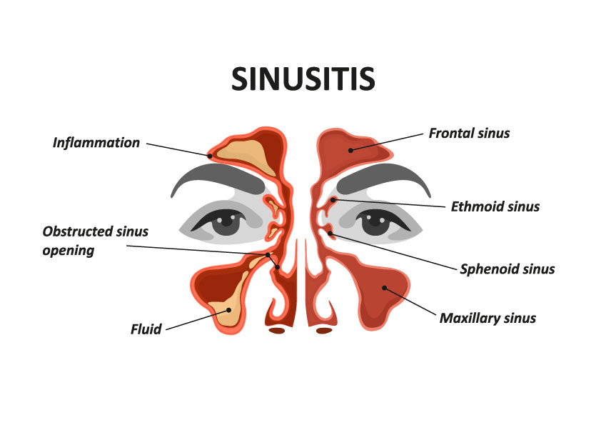 Prevenção a Longo Prazo: Dicas Para Manter os Fungos Longe - inspiração 1