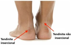 Fortalecimento Muscular: Músculos Fortes Protegem o Tendão - inspiração 2
