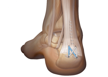 Calçados Adequados: O Suporte Que Seus Pés Precisam - inspiração 2