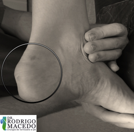 Palmilhas e Órteses: Correção e Alívio da Pressão - inspiração 2