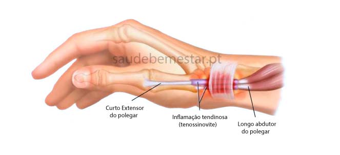 O que é exatamente a Tendinite de Quervain? - inspiração 2