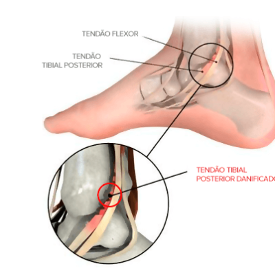 Repouso Estratégico: Dando um Respiro para o Seu Pé - inspiração 1