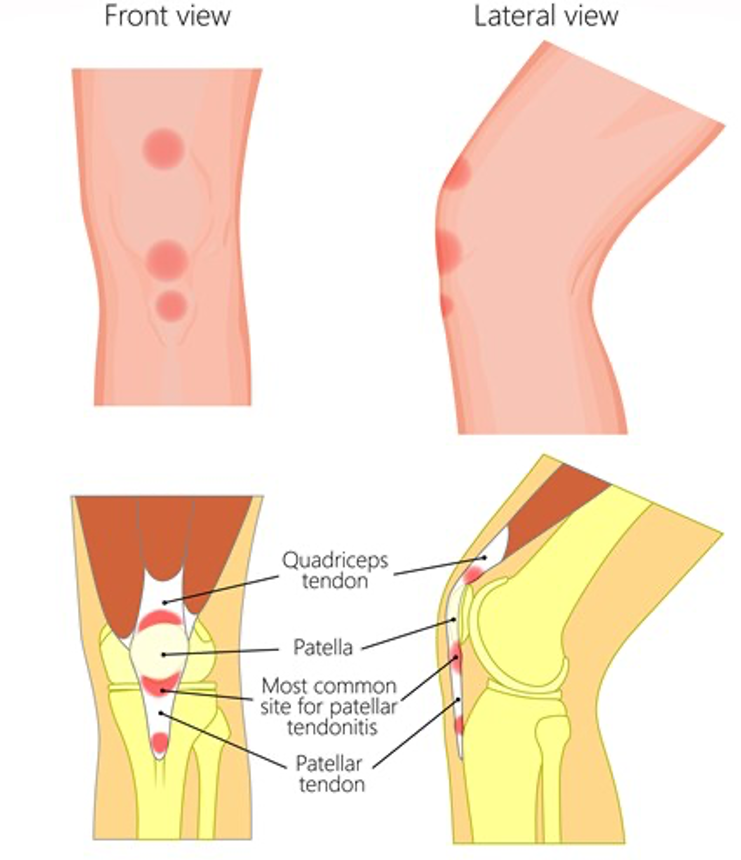 Prevenção Contínua: Mantenha Suas Articulações Saudáveis a Longo Prazo - inspiração 2