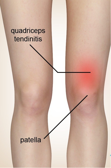 Medicamentos Com e Sem Prescrição: Opções para Controle da Dor - inspiração 2