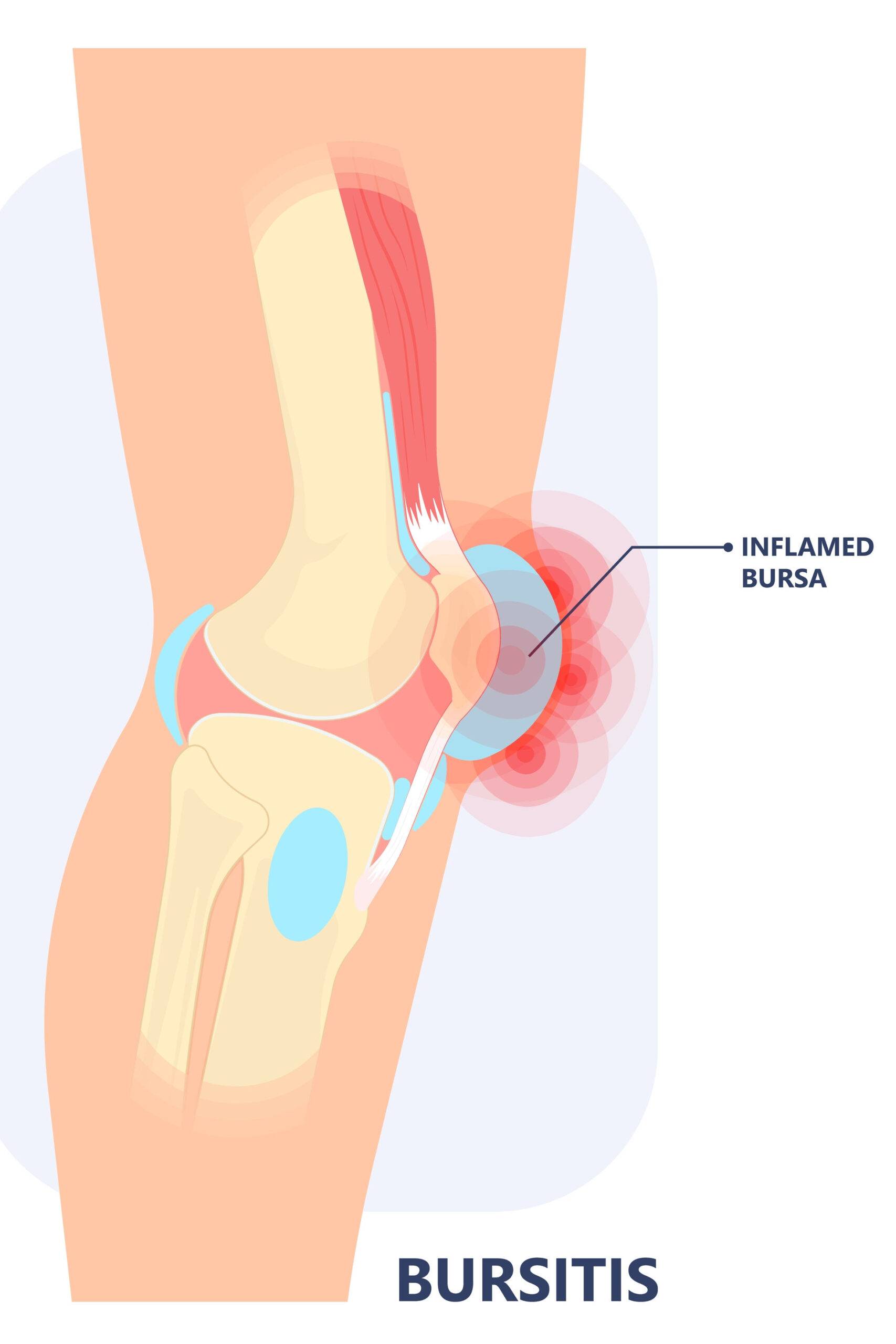 Injeções Terapêuticas: Quando Considerar Essa Alternativa? - inspiração 1