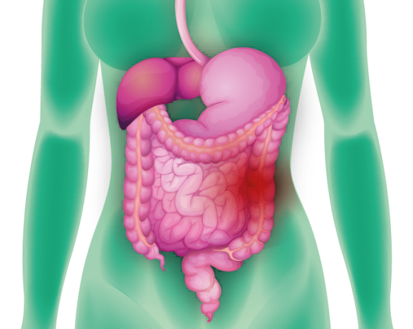 Hérnia: O Protrusão Que Causa Dor - inspiração 2